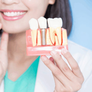 Implantes