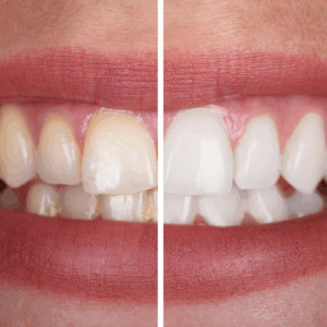 Clareamento Dental