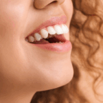 Restauração de Resina